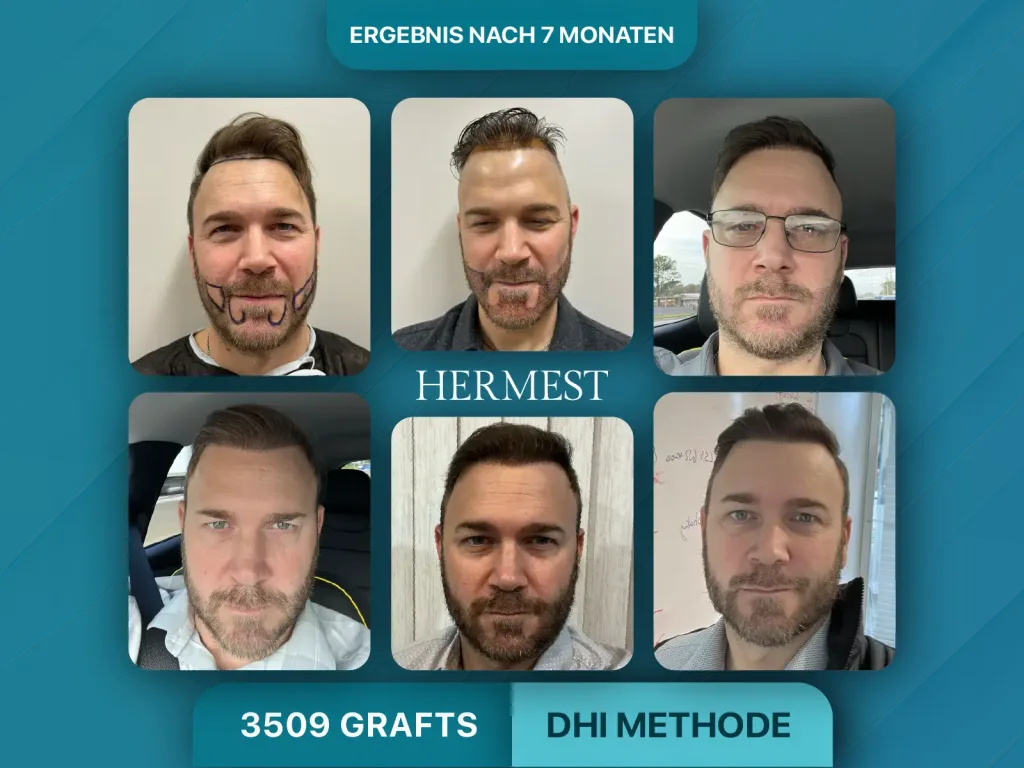 DHI Haartransplantation vorher nachher 3509 Grafts