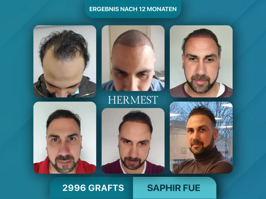 Haartransplantation vorher nachehr 2996 Grafts