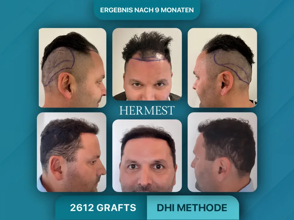 Haartransplantation vorher nachher 2612 Grafts