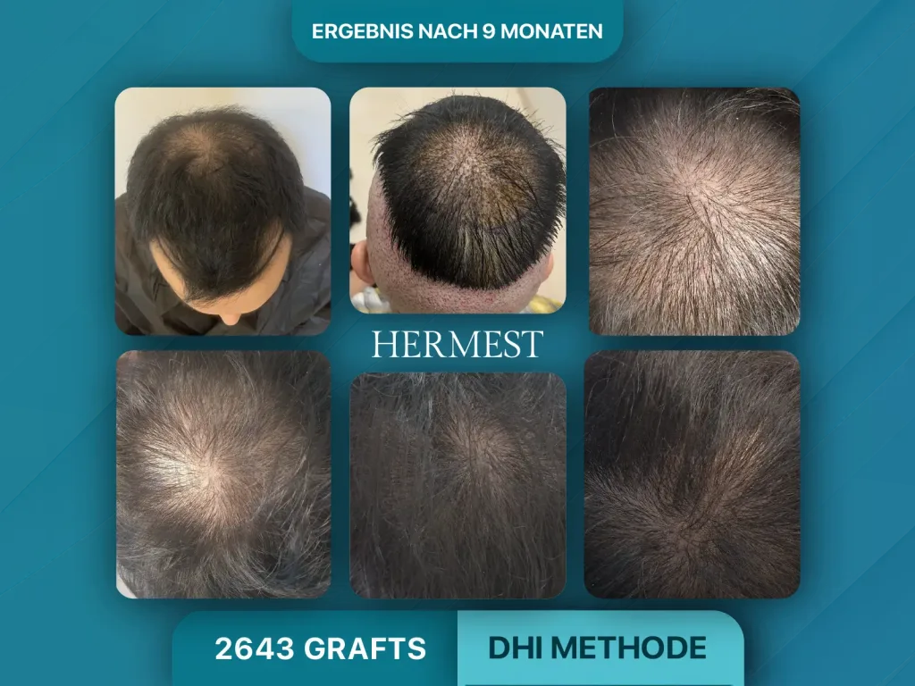 Haartransplantation vorher nachher 2643 Grafts