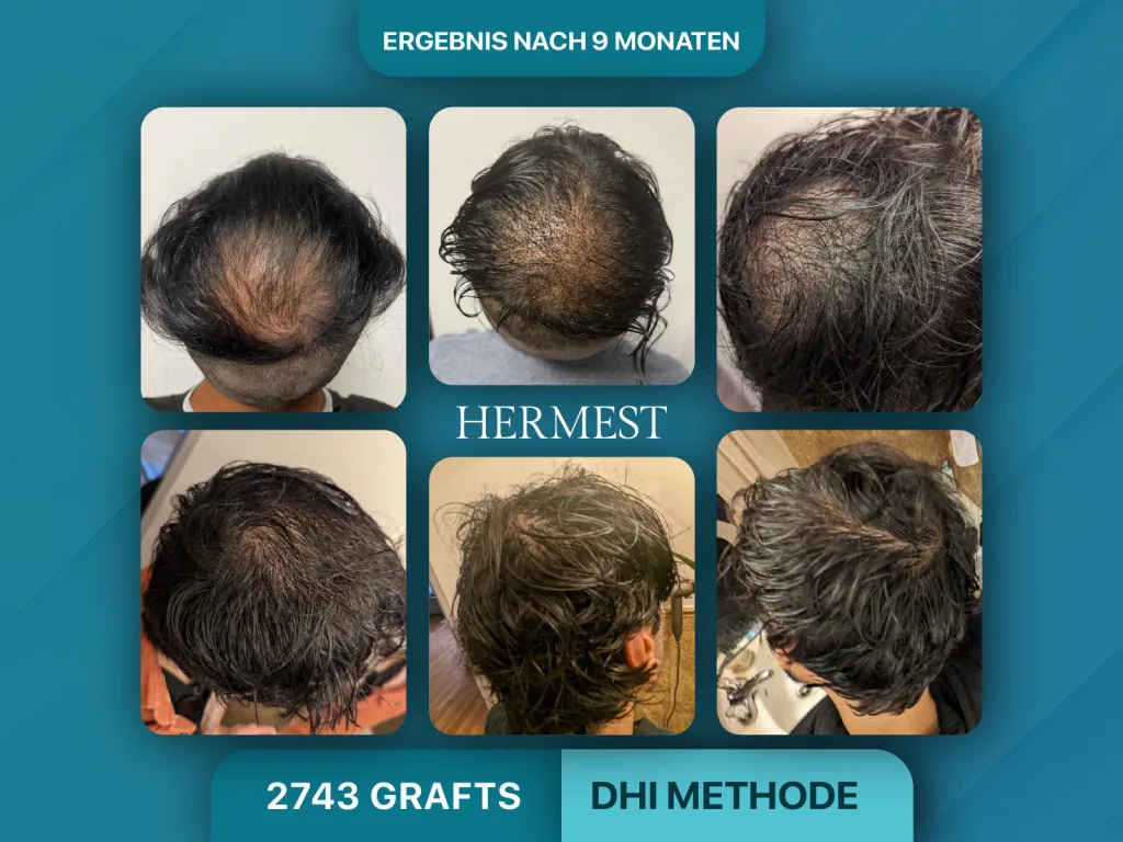 Haartransplantation vorher nachher 2743 Grafts
