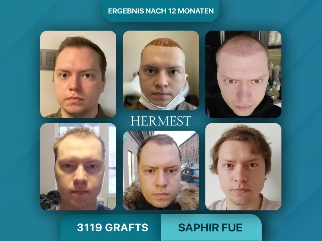 Haartransplantation vorher nachher 3199 Grafts