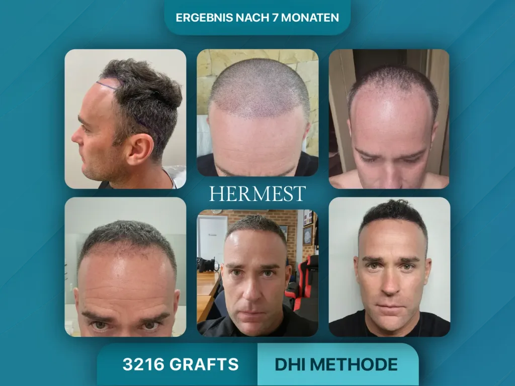 Haartransplantation vorher nachher 3216 Grafts