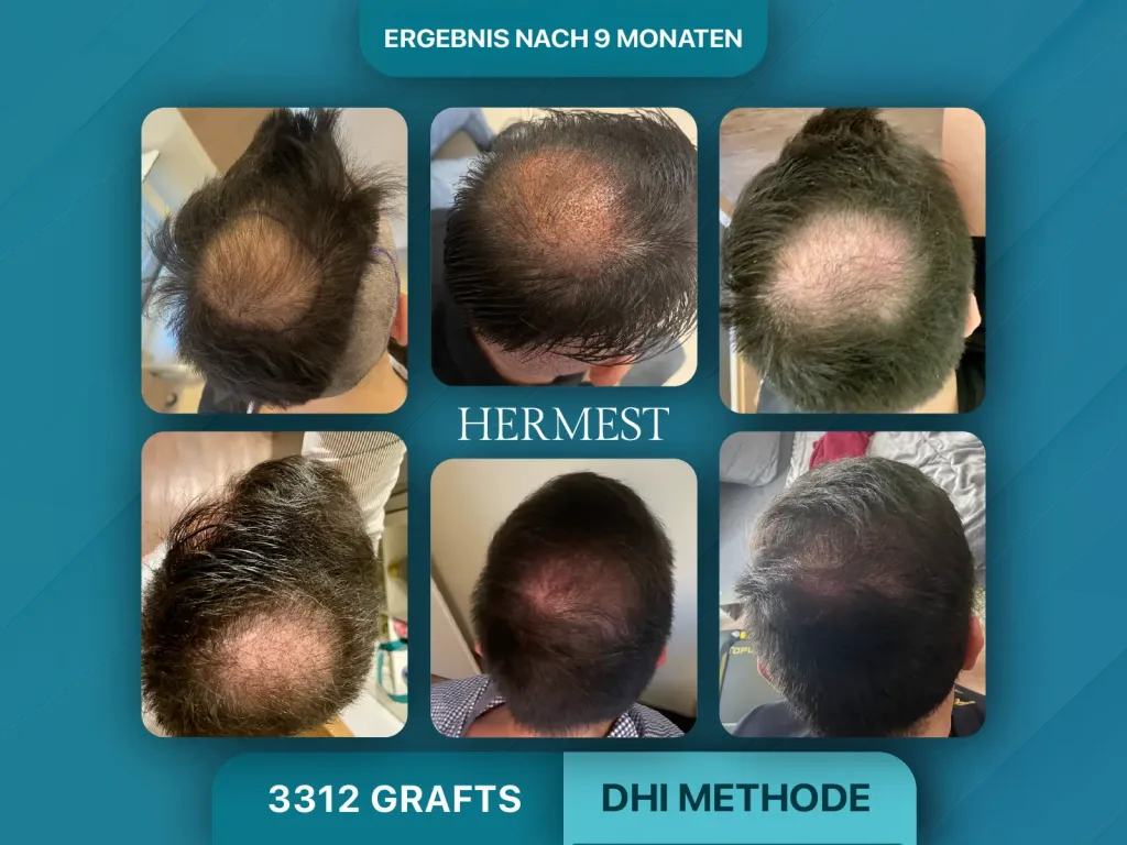 Haartransplantation vorher nachher 3312 Grafts