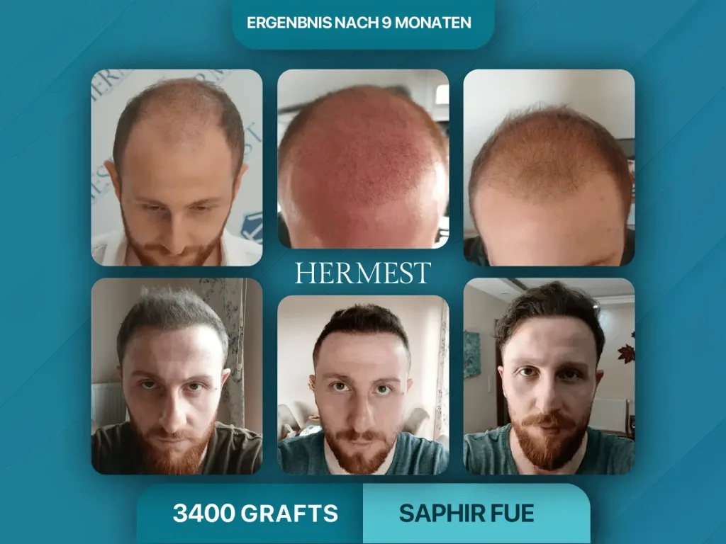 Haartransplantation vorher nachher 3400 Grafts