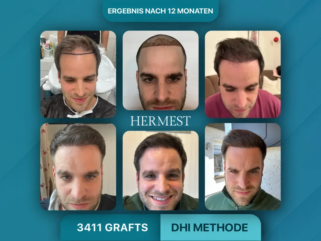 Haartransplantation vorher nachher 3411 Grafts