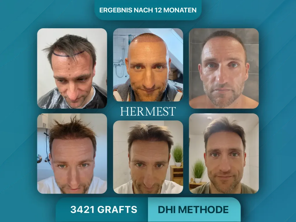 Haartransplantation vorher nachher 3421 Grafts