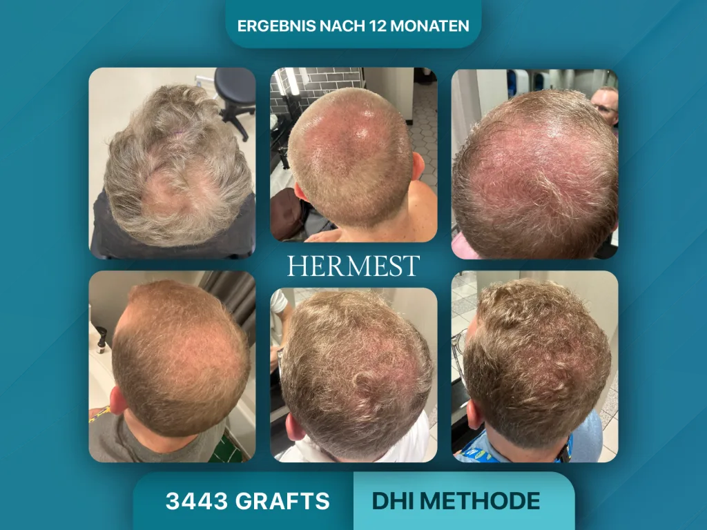 Haartransplantation vorher nachher 3443 Grafts