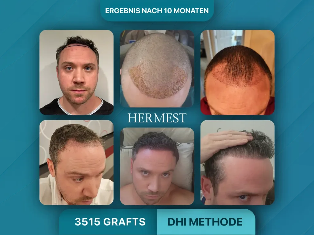 Haartransplantation vorher nachher 3515 Grafts
