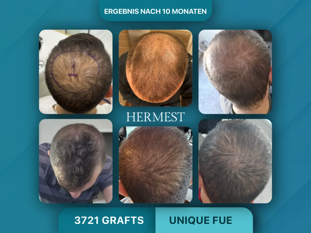Haartransplantation vorher nachher 3721 Grafts