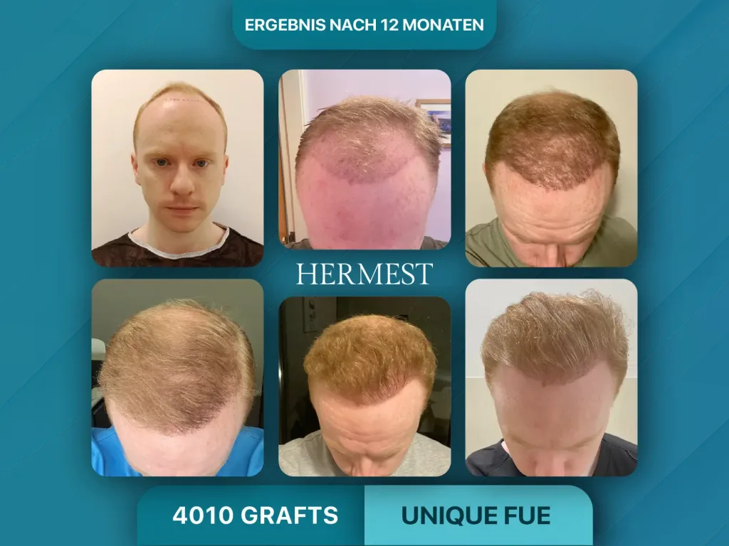 Haartransplantation vorher nachher 4010 Grafts