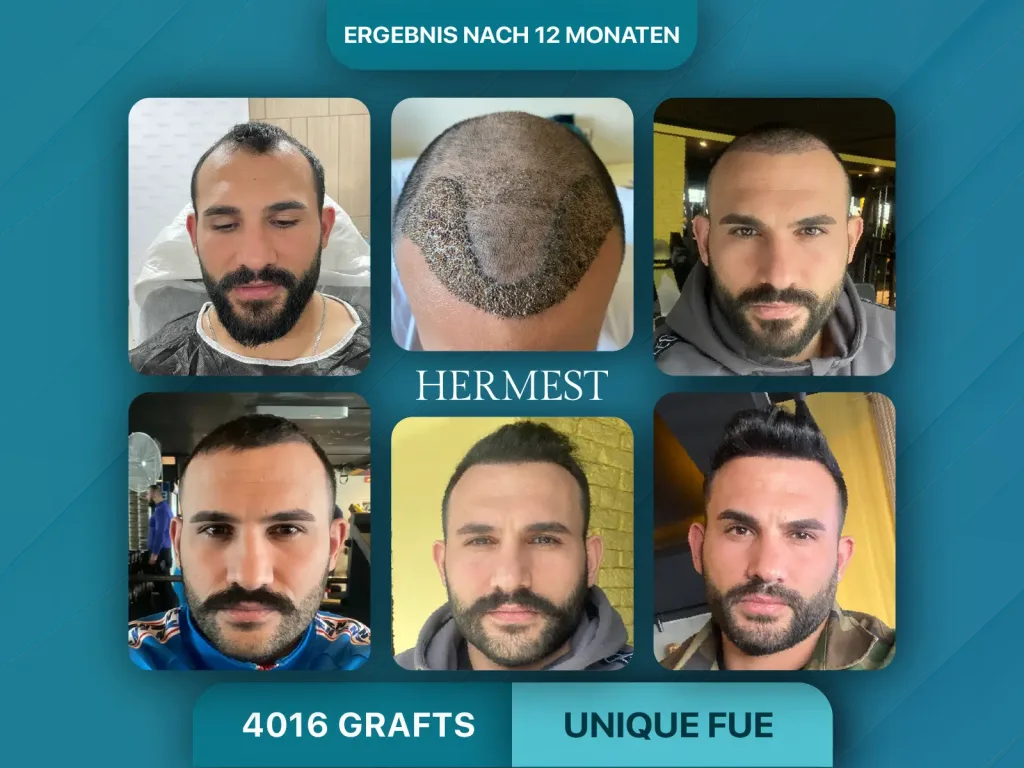 Haartransplantation vorher nachher 4016 Grafts