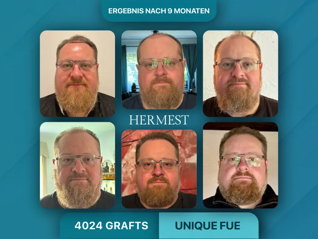 Haartransplantation vorher nachher 4024 Grafts