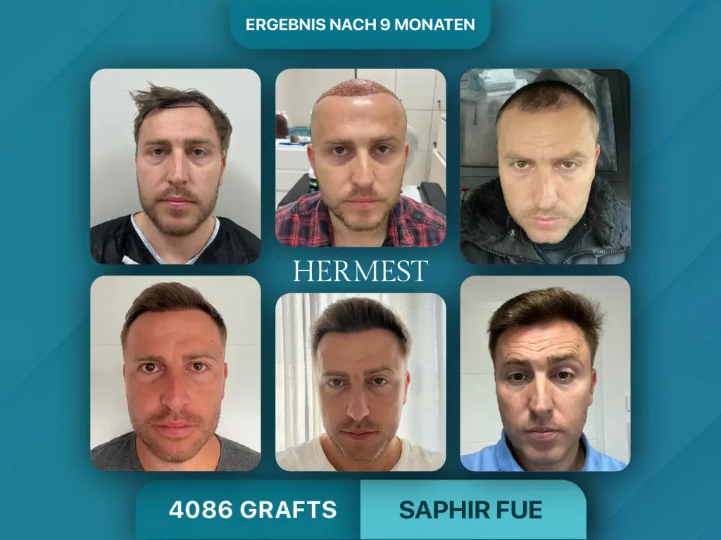Haartransplantation vorher nachher 4086 Grafts
