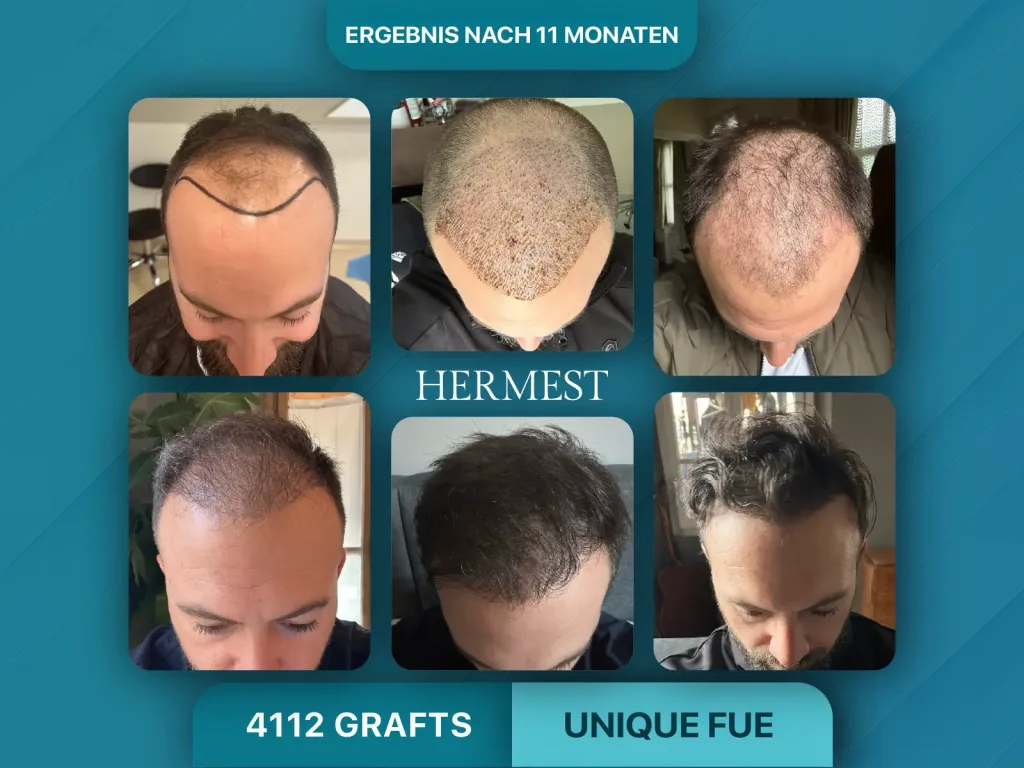 Haartransplantation vorher nachher 4112 Grafts