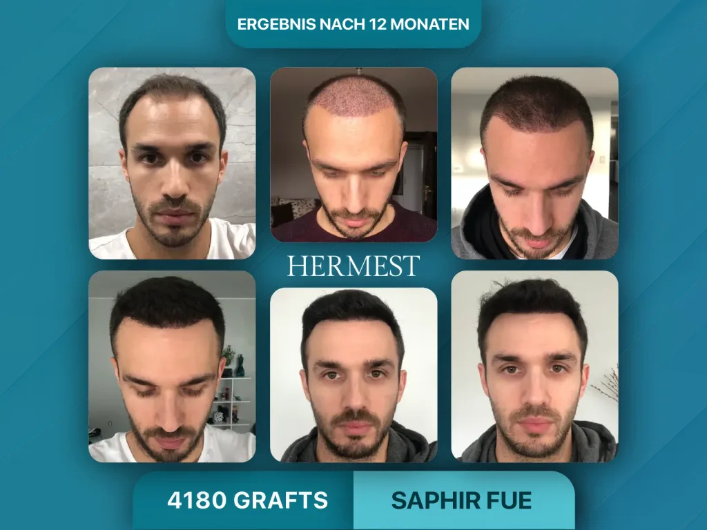 Haartransplantation vorher nachher 4180 Grafts