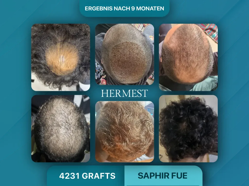 Haartransplantation vorher nachher 4231 Grafts