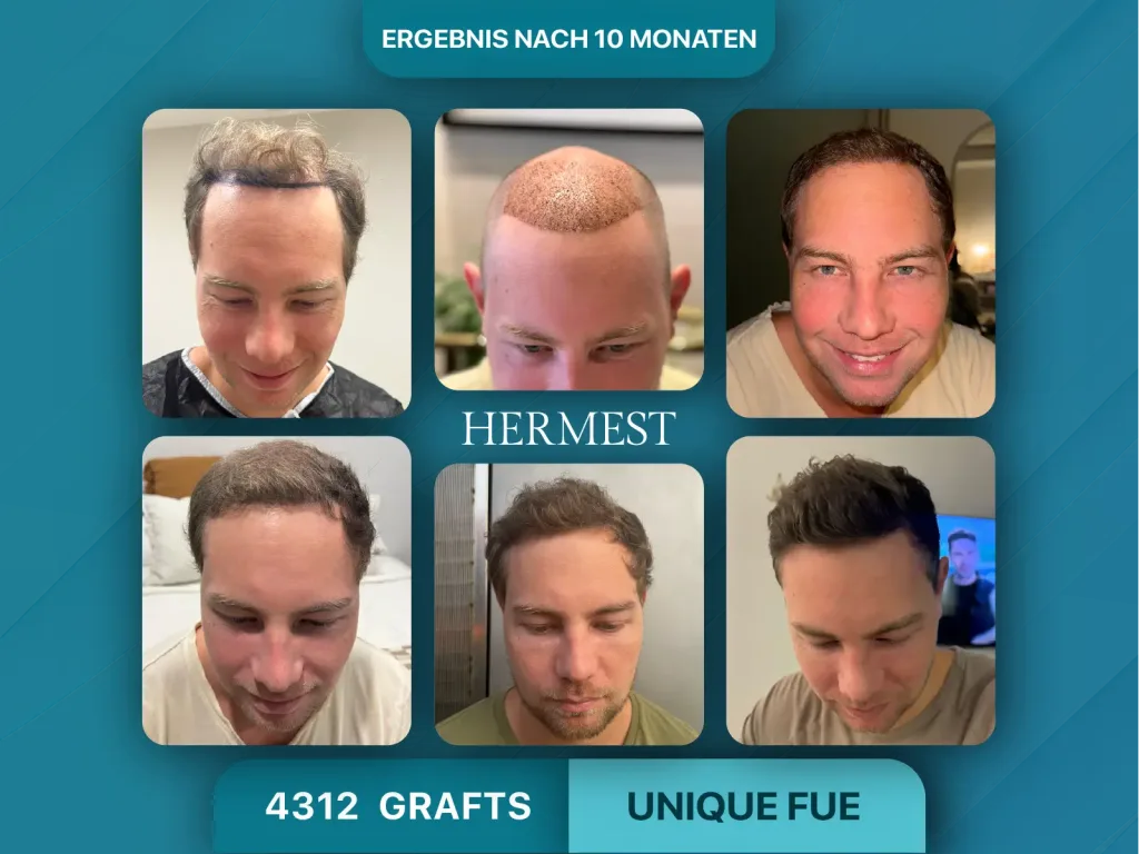 Haartransplantation vorher nachher 4312 Grafts