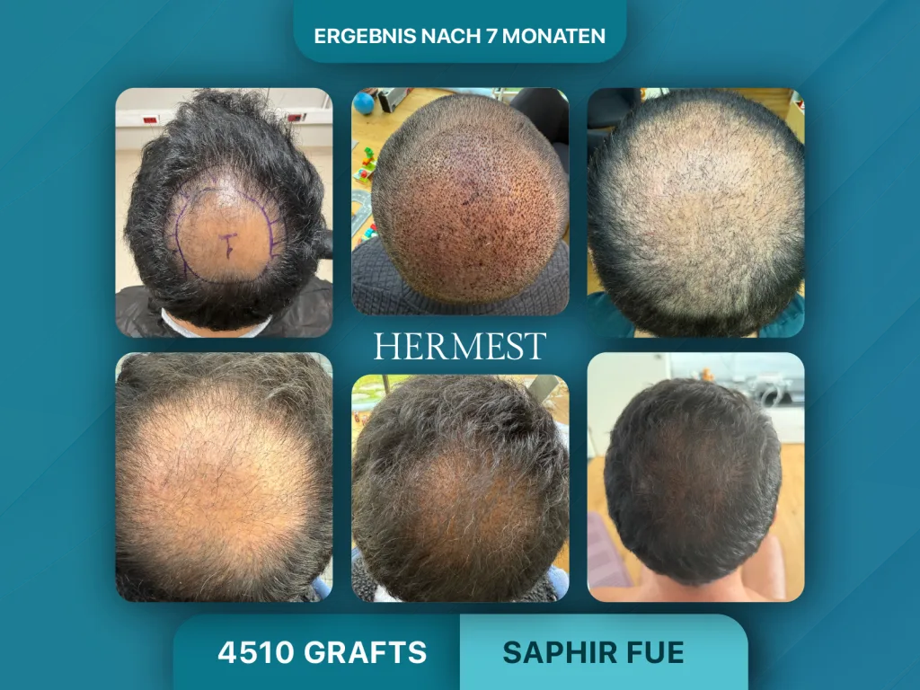Haartransplantation vorher nachher 4510 Grafts
