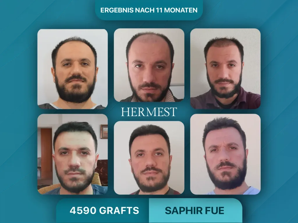 Haartransplantation vorher nachher 4590 Grafts