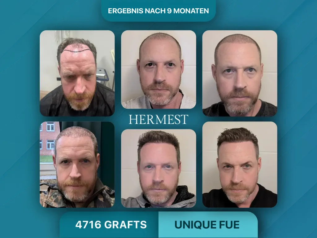 Haartransplantation vorher nachher 4716 Grafts