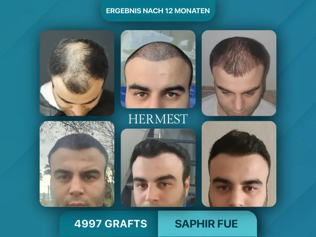 Haartransplantation vorher nachher 4887 Grafts