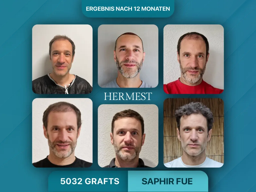 Haartransplantation vorher nachher 5032 Grafts