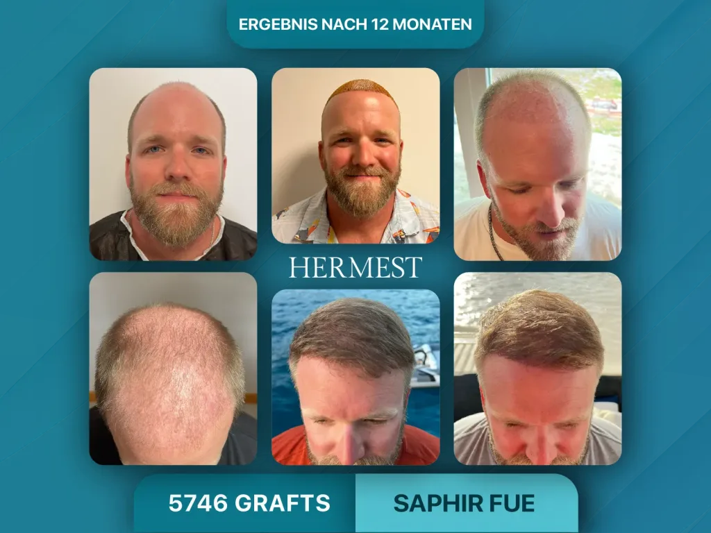 Haartransplantation vorher nachher 5746 Grafts