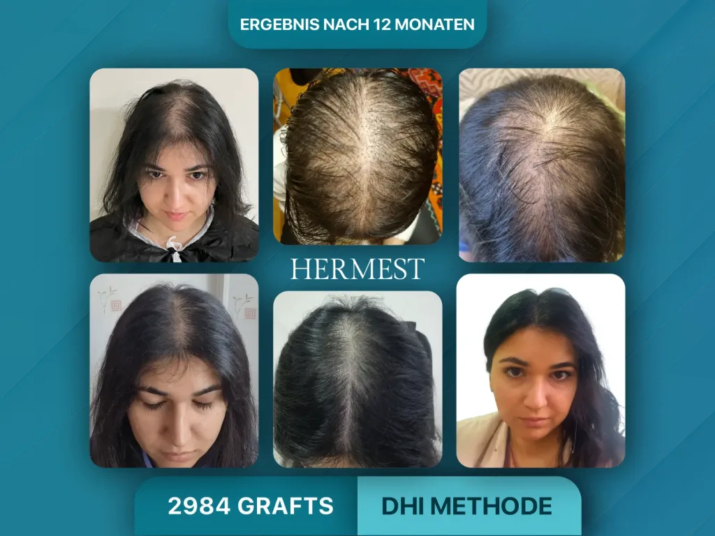 Haartransplantation vorher nachher Frauen 2984 Grafts