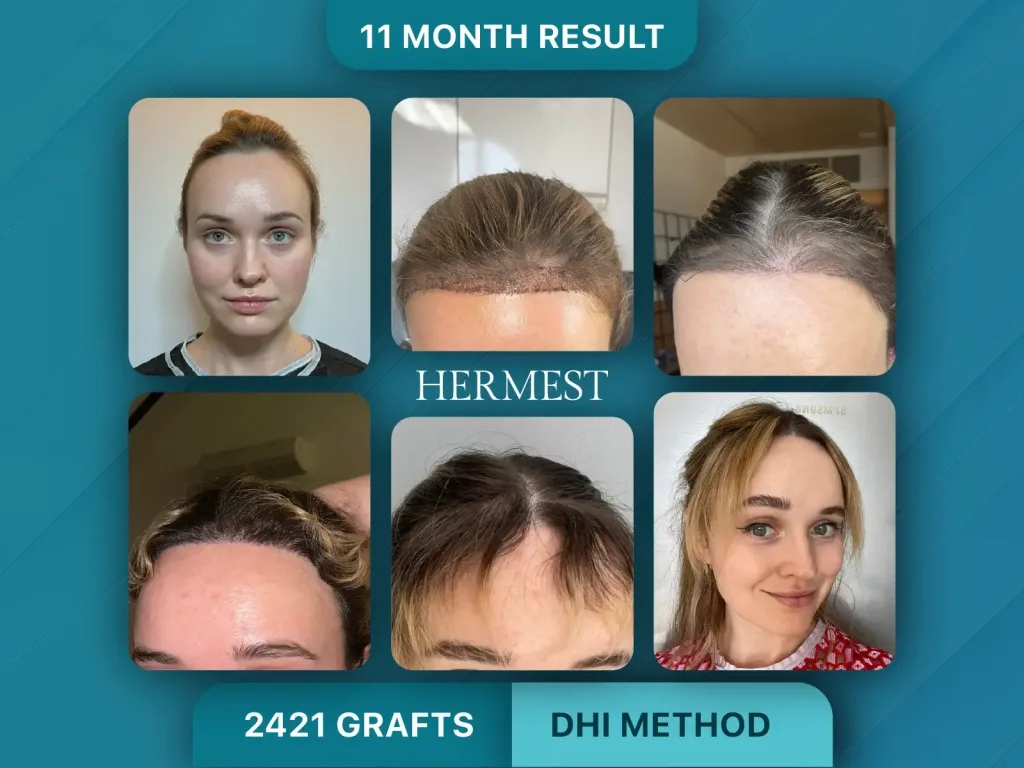 Trapianto di capelli prima e dopo, Metodo DHI – 2421 innesti
