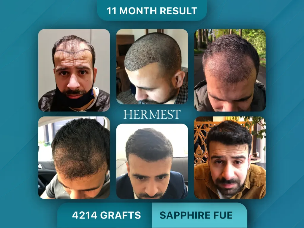 Trapianto di capelli prima e dopo, Sapphire FUE – 4214 innesti