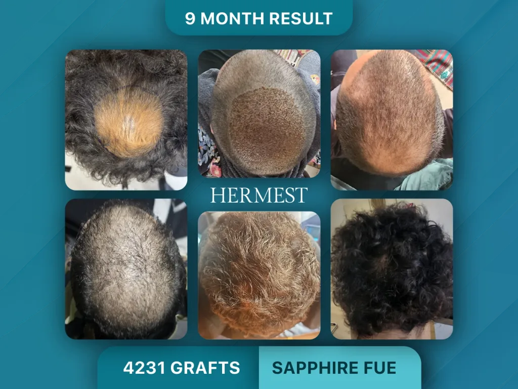 Trapianto di capelli prima e dopo, Sapphire FUE – 4231 innesti