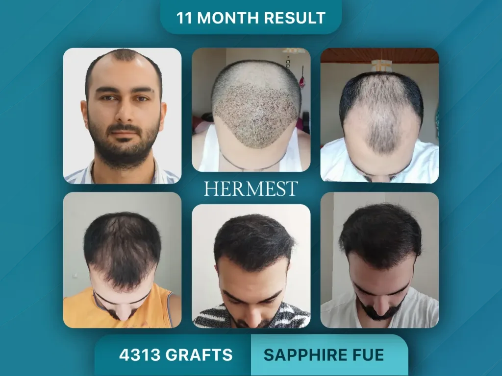 Trapianto di capelli prima e dopo, Sapphire FUE – 4313 innesti