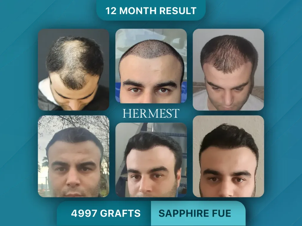 Trapianto di capelli prima e dopo, Sapphire FUE – 4997 innesti