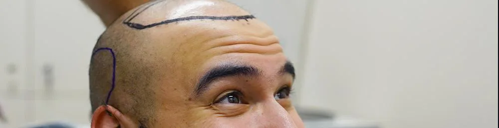 hair transplant to the crown area