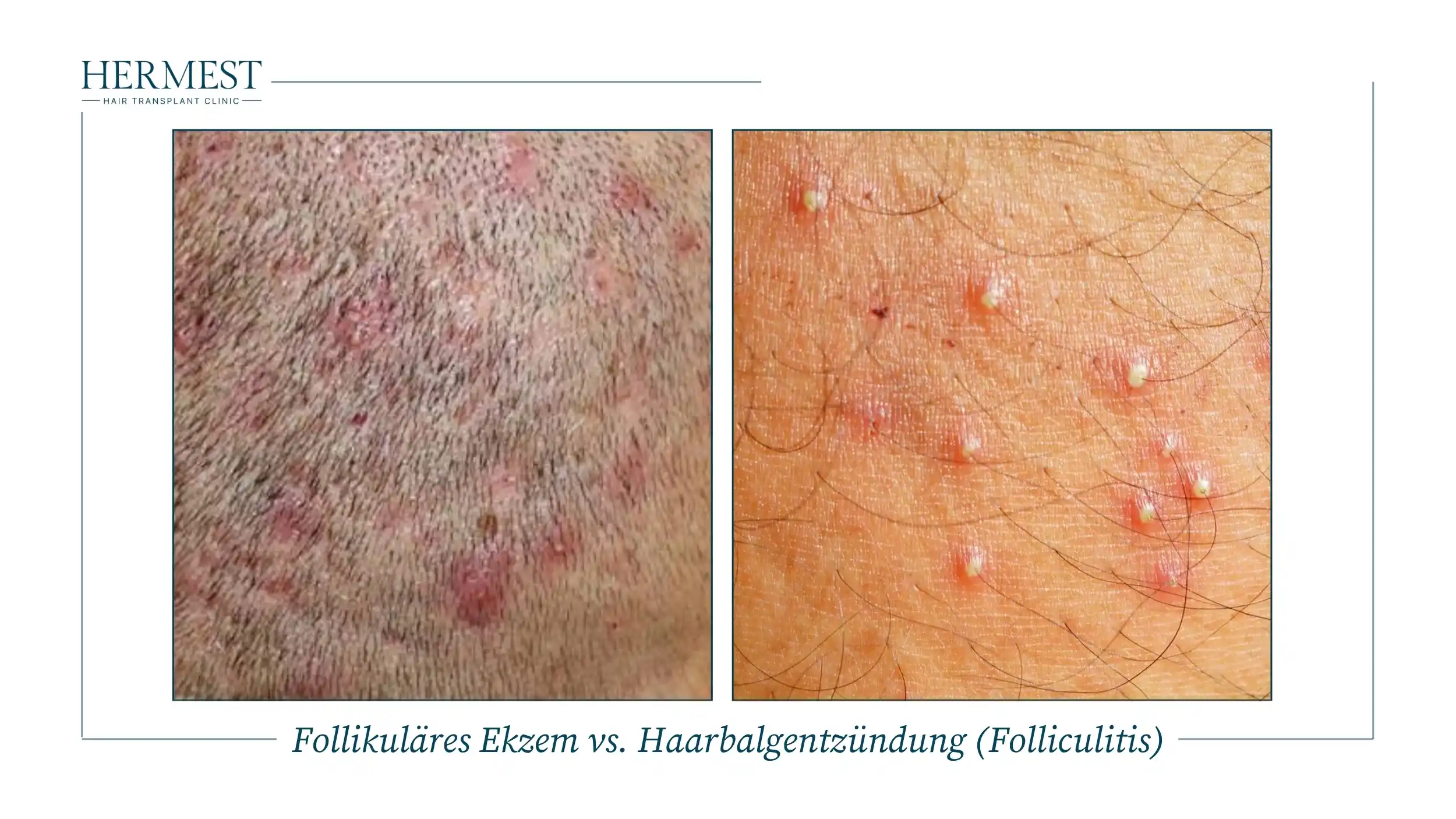 Follikuläres Ekzem vs. Haarbalgentzündung (Folliculitis)