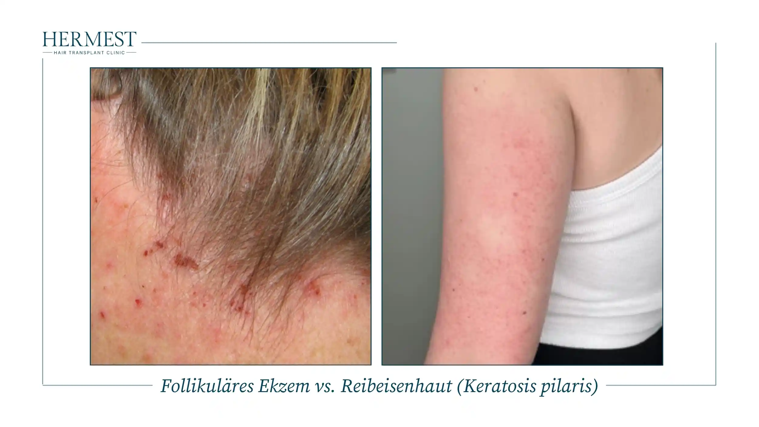 Follikuläres Ekzem vs. Reibeisenhaut (Keratosis pilaris)