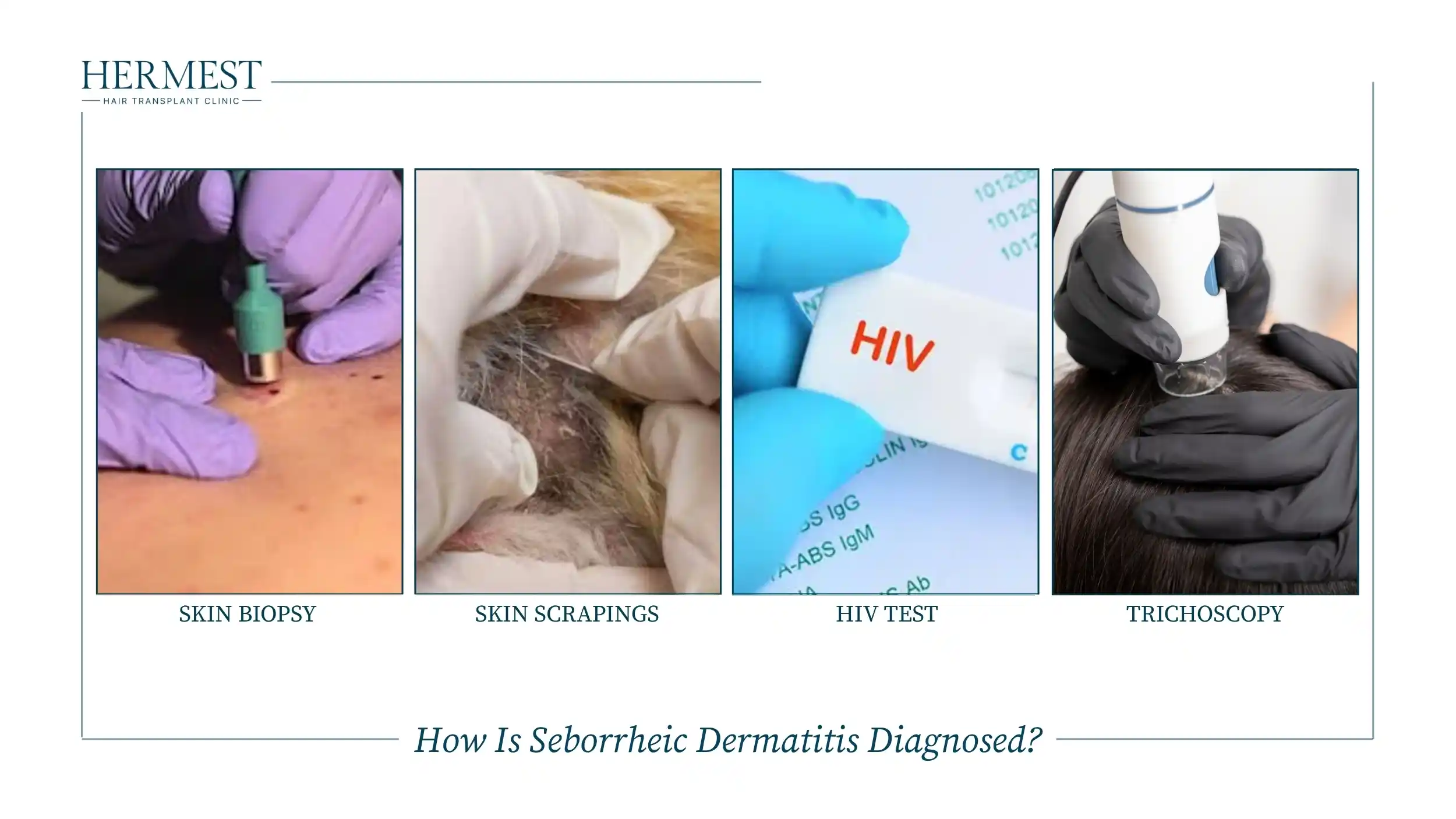 Tests used to diagnose seborrheic dermatitis: skin biopsy, skin scrapings, HIV test, and trichoscopy of the scalp