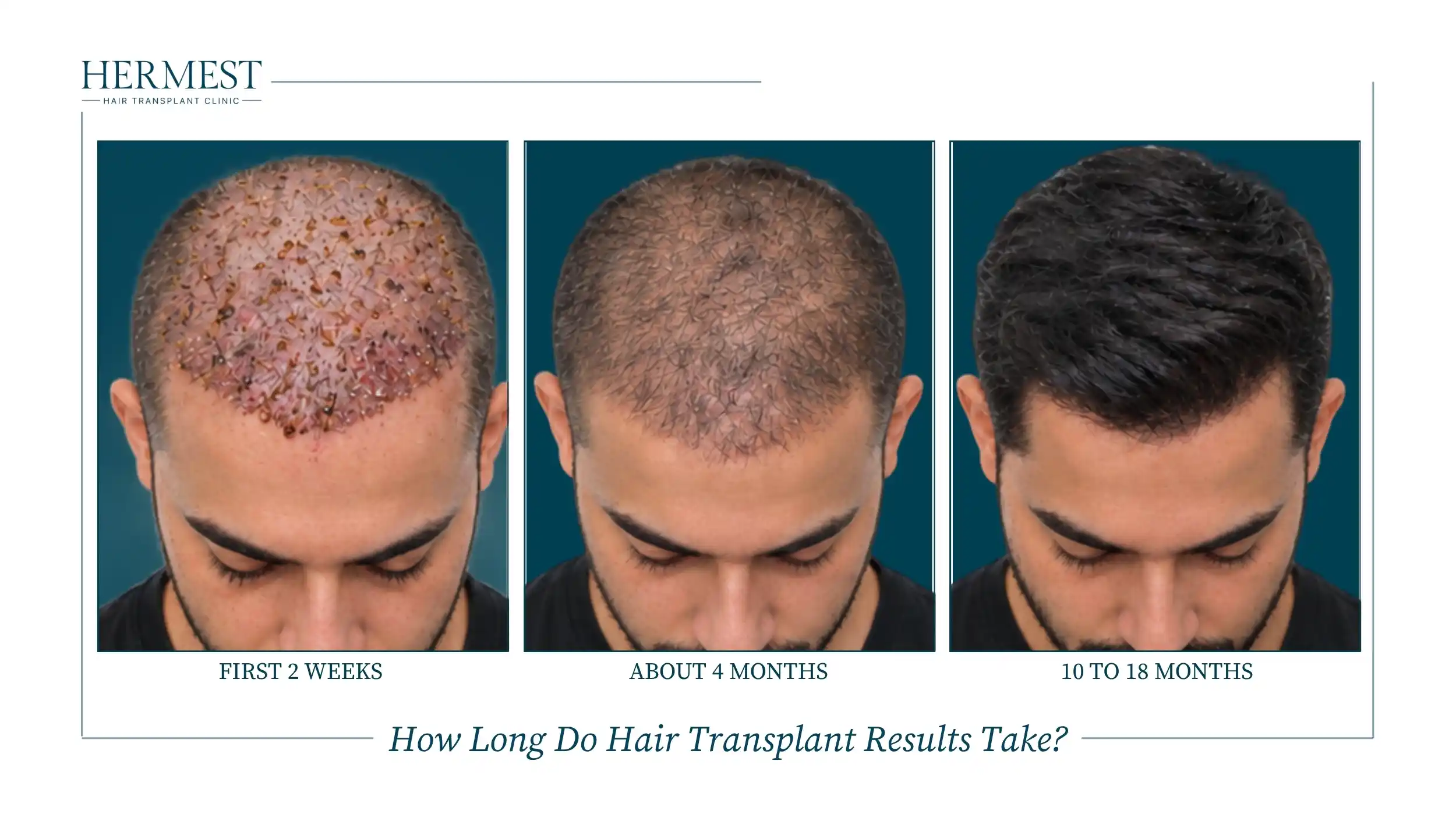Hair transplant recovery on one patient: scabbing in the first 2 weeks, early regrowth at about 4 months and the full result at 10 to 18 months