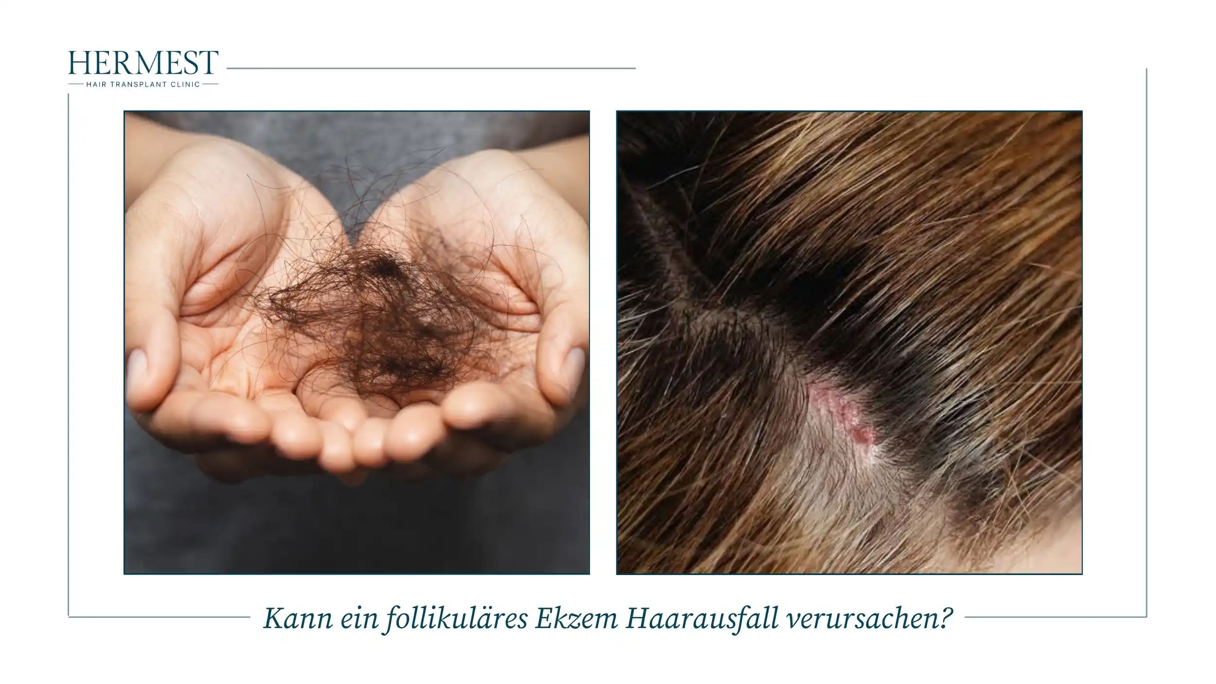 Kann ein follikuläres Ekzem Haarausfall verursachen