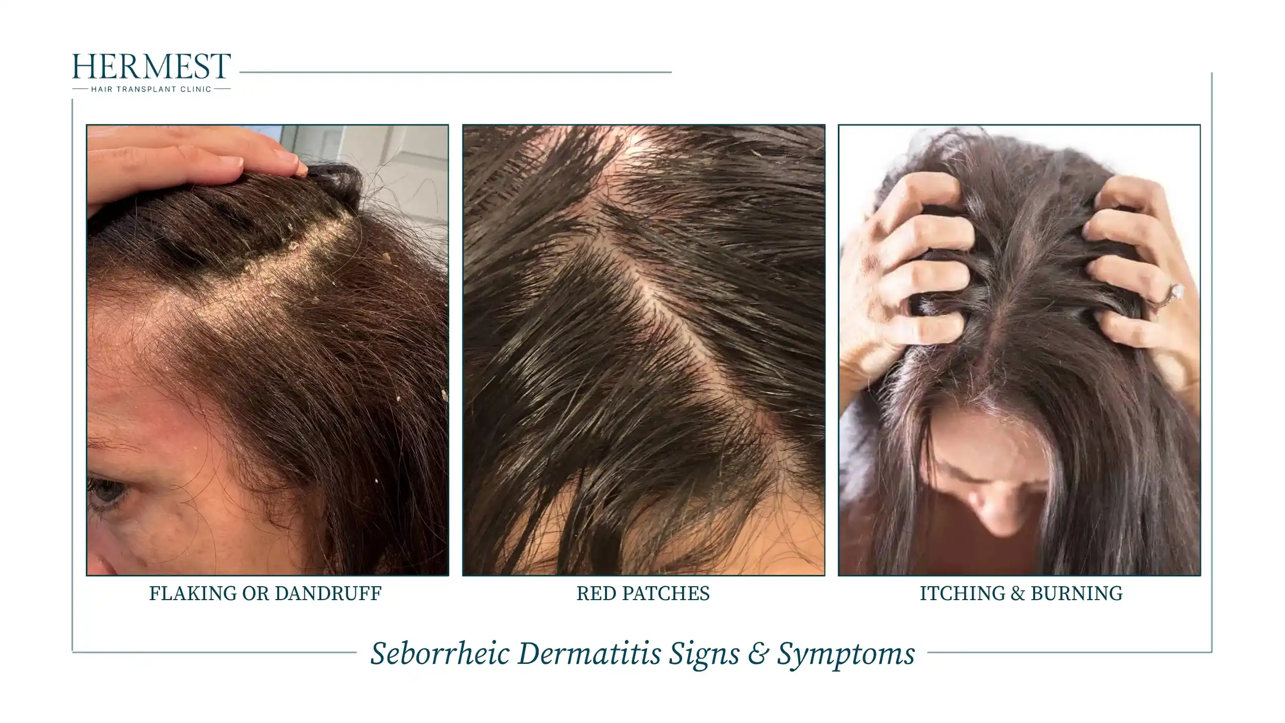 Seborrheic dermatitis signs and symptoms: flaking or dandruff along the parting, red patches on the scalp, and itching and burning