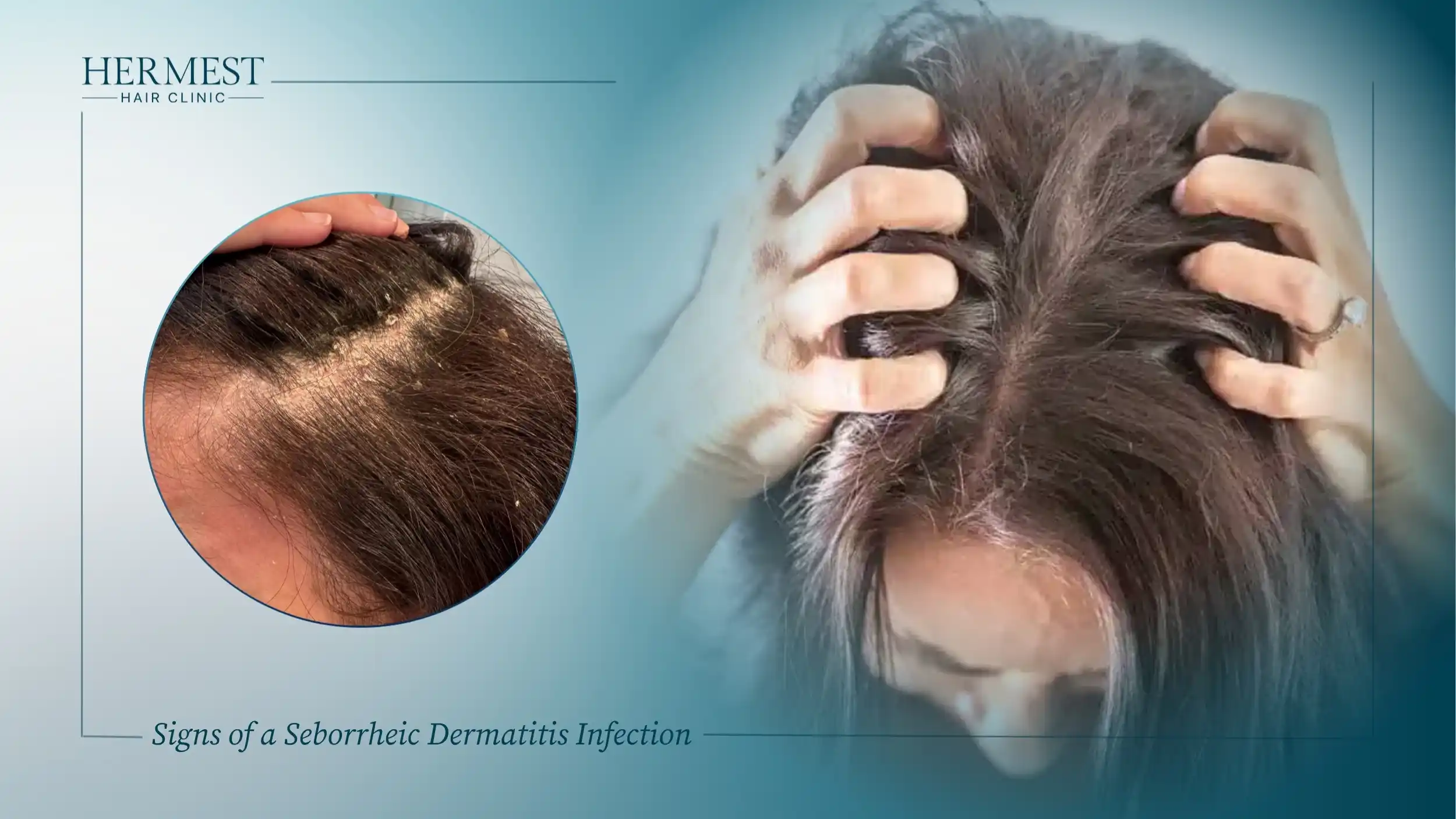 Woman scratching an itchy scalp, with a close-up of flaky seborrheic dermatitis scale along her hair parting