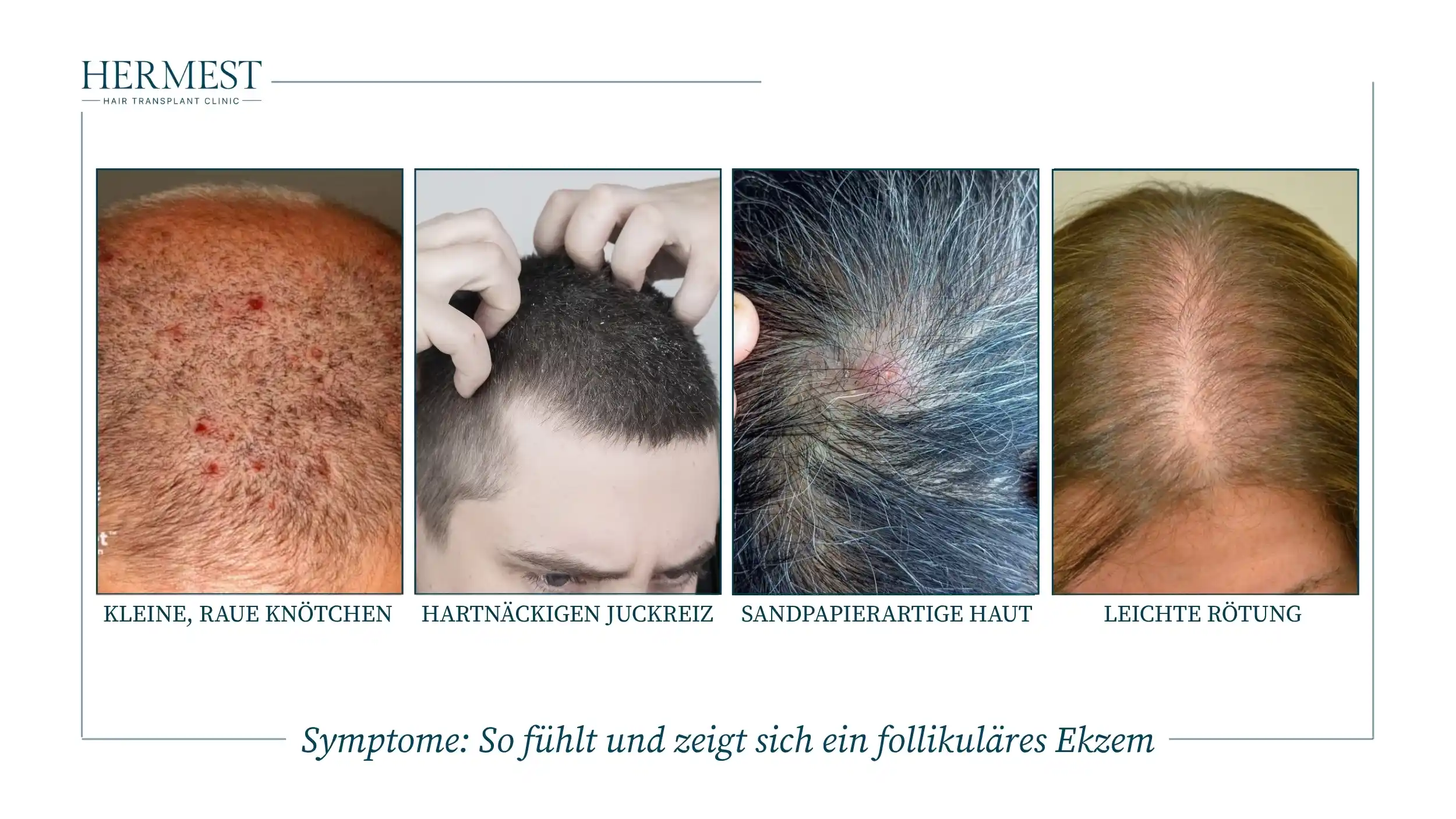 Symptome So fühlt und zeigt sich ein follikuläres Ekzem