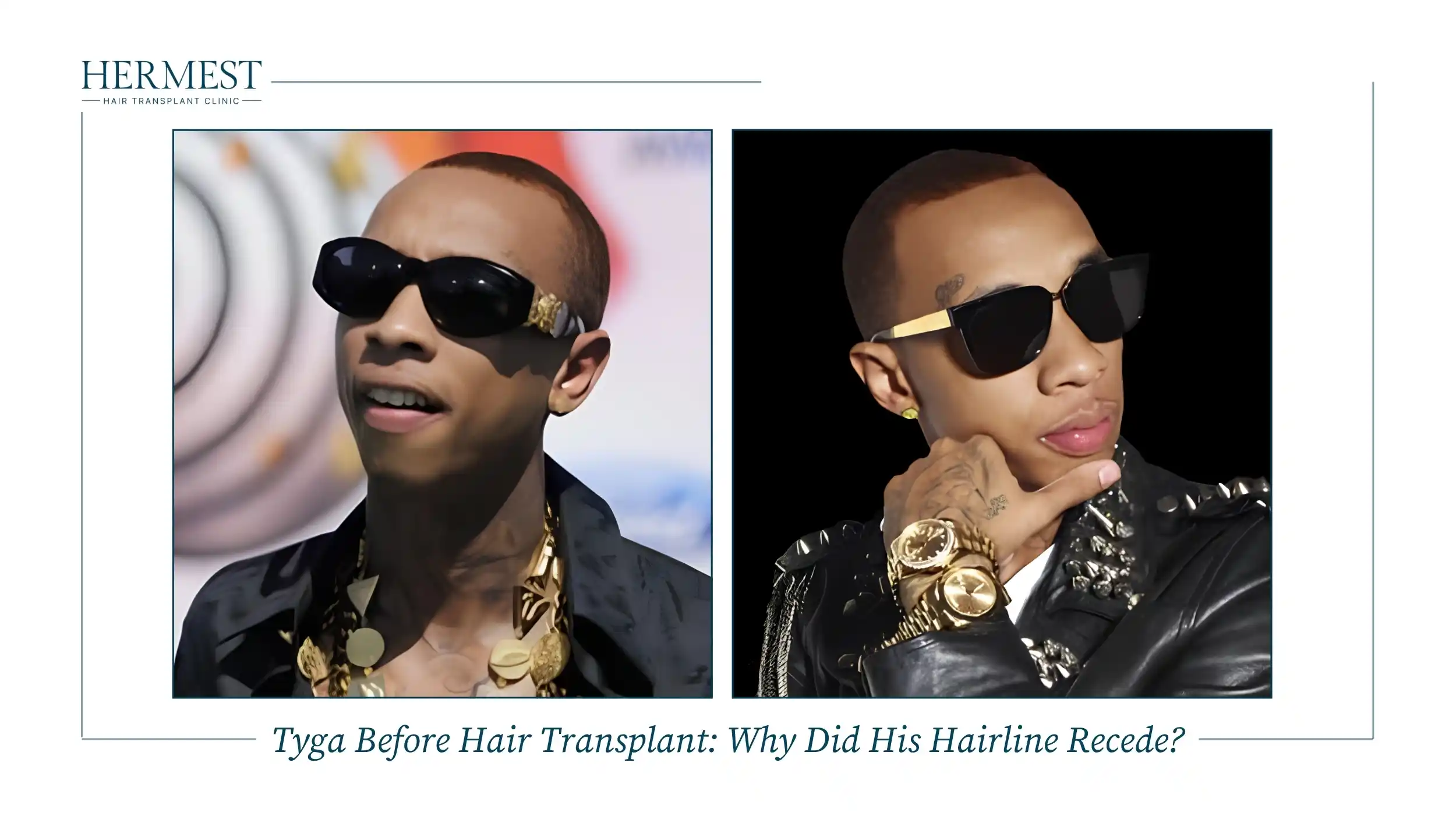 Two photos of Tyga before his hair transplant with very short hair and a high, receded hairline