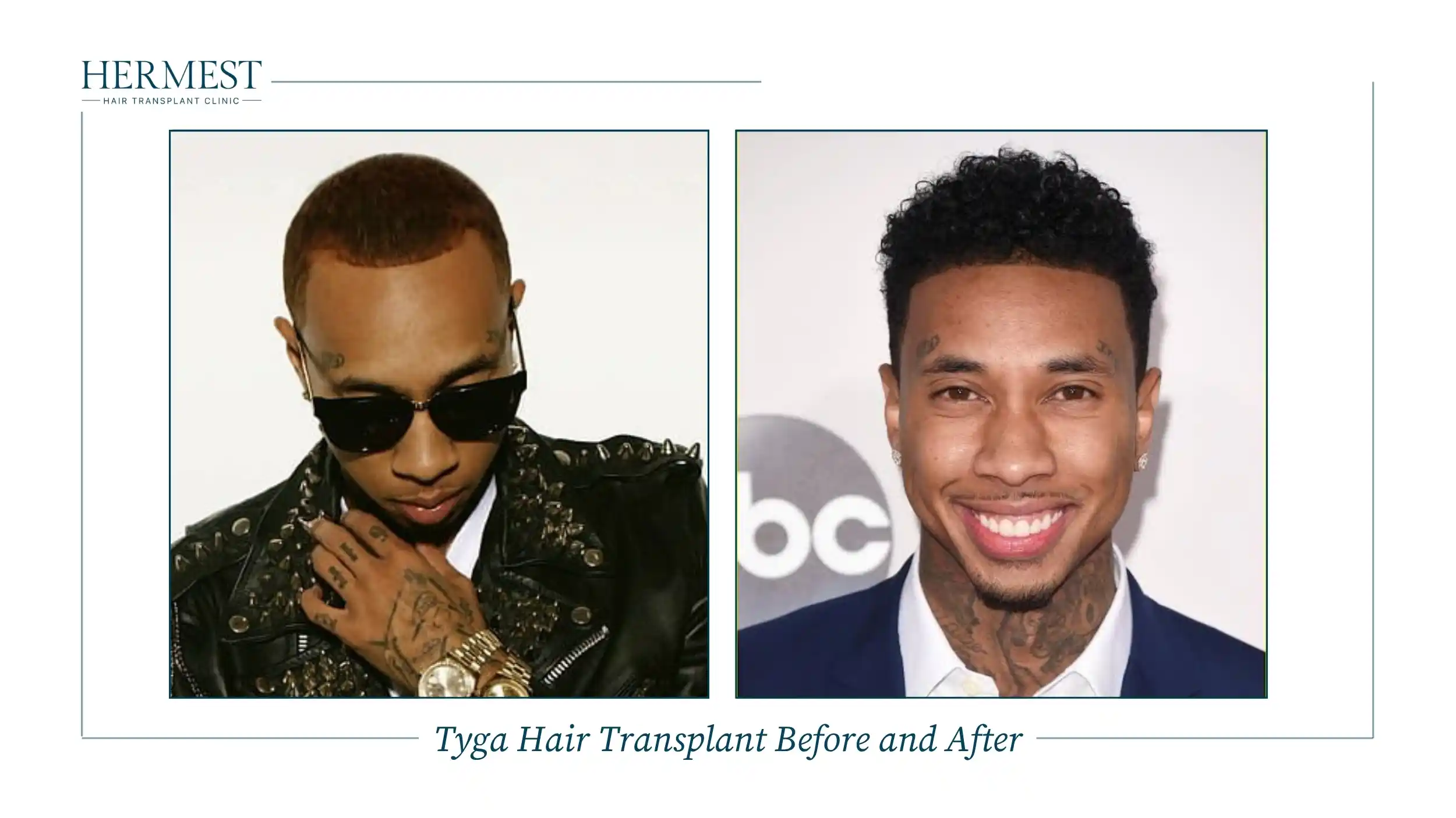 Tyga before and after his hair transplant: a receded hairline with short hair, then a lower, fuller curly hairline