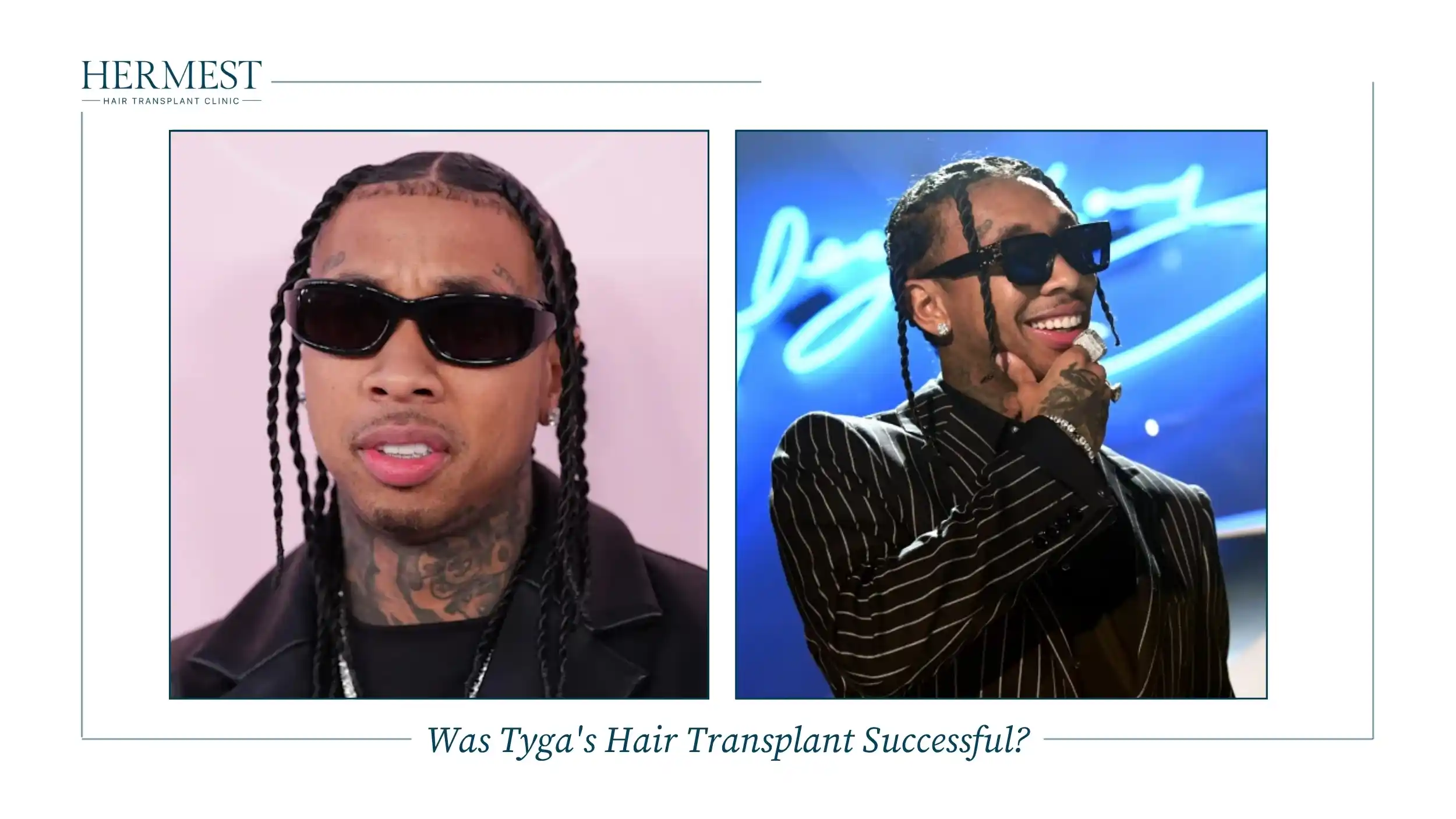 Two recent photos of Tyga in braids showing his hairline years after the transplant