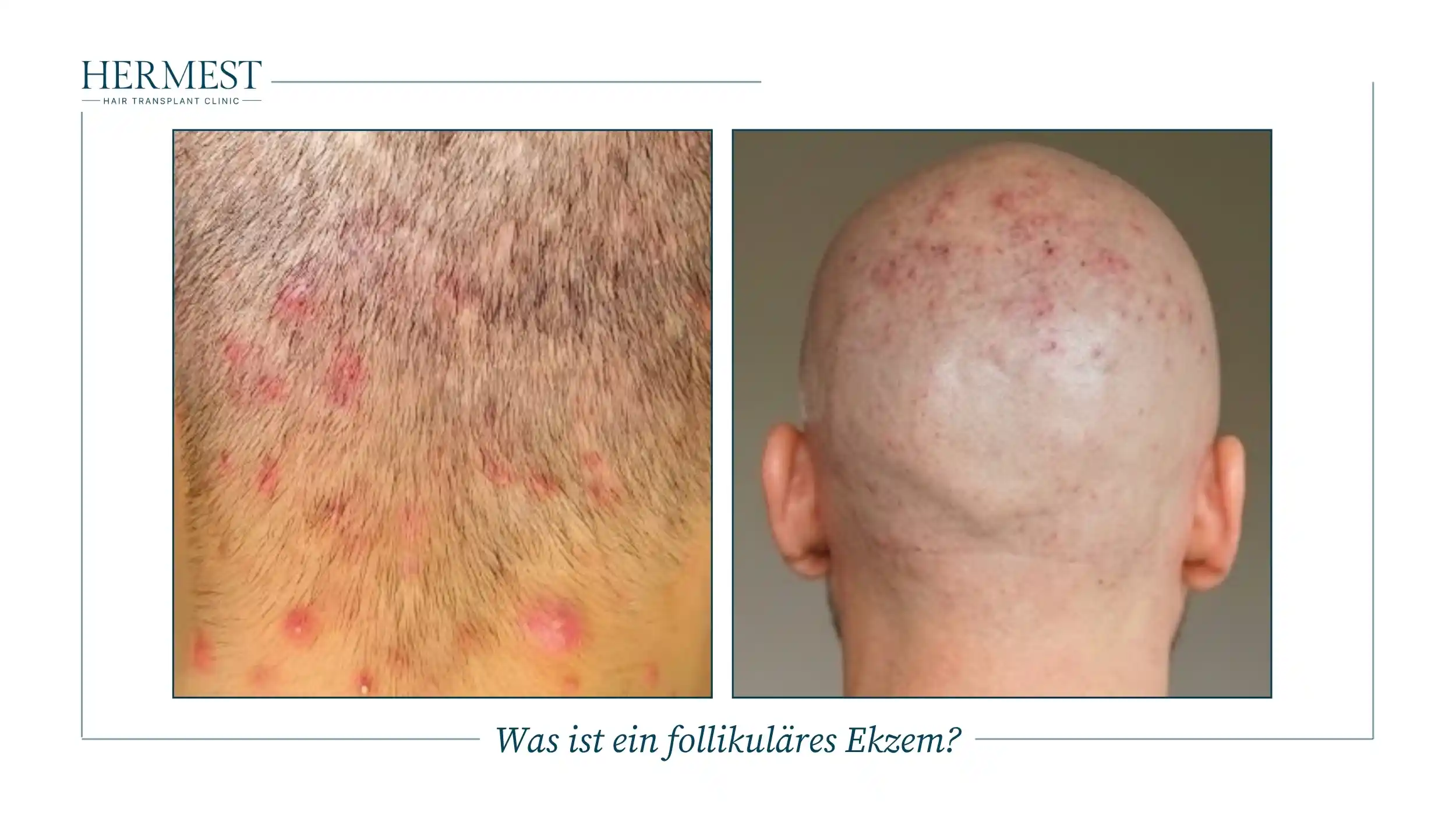 Was ist ein follikuläres Ekzem