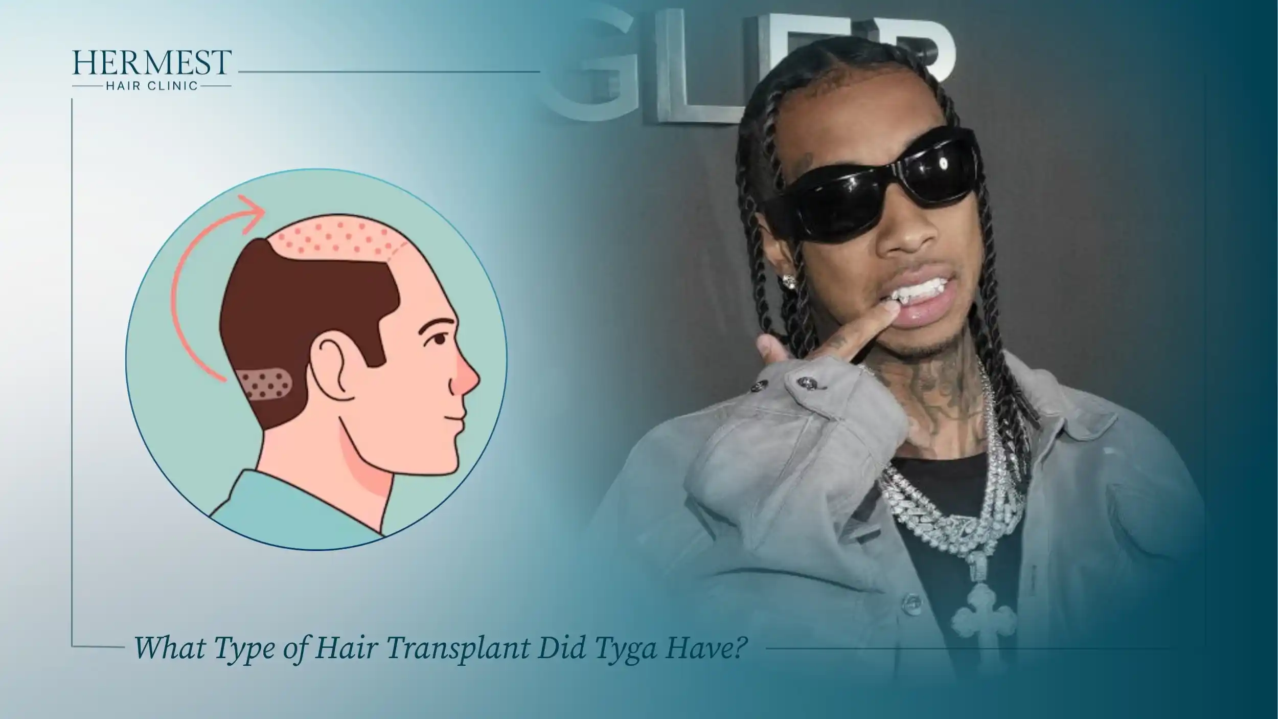 Illustration of an FUE hair transplant moving grafts from the back of the head to the hairline, beside a photo of Tyga