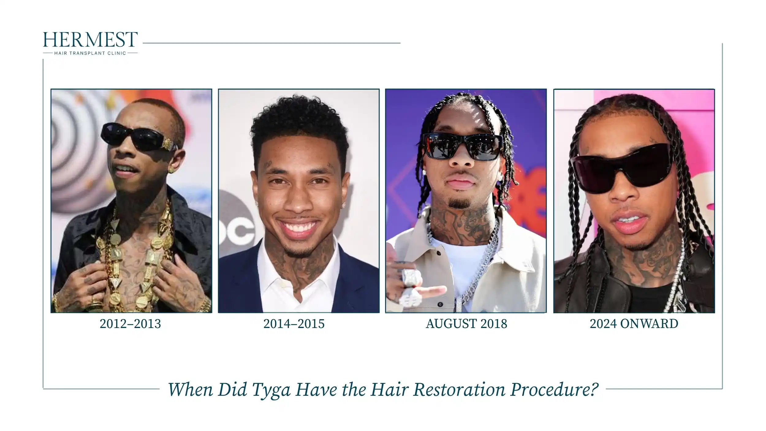 Tyga hairline timeline in four photos: 2012 to 2013, 2014 to 2015, August 2018 and 2024 onward