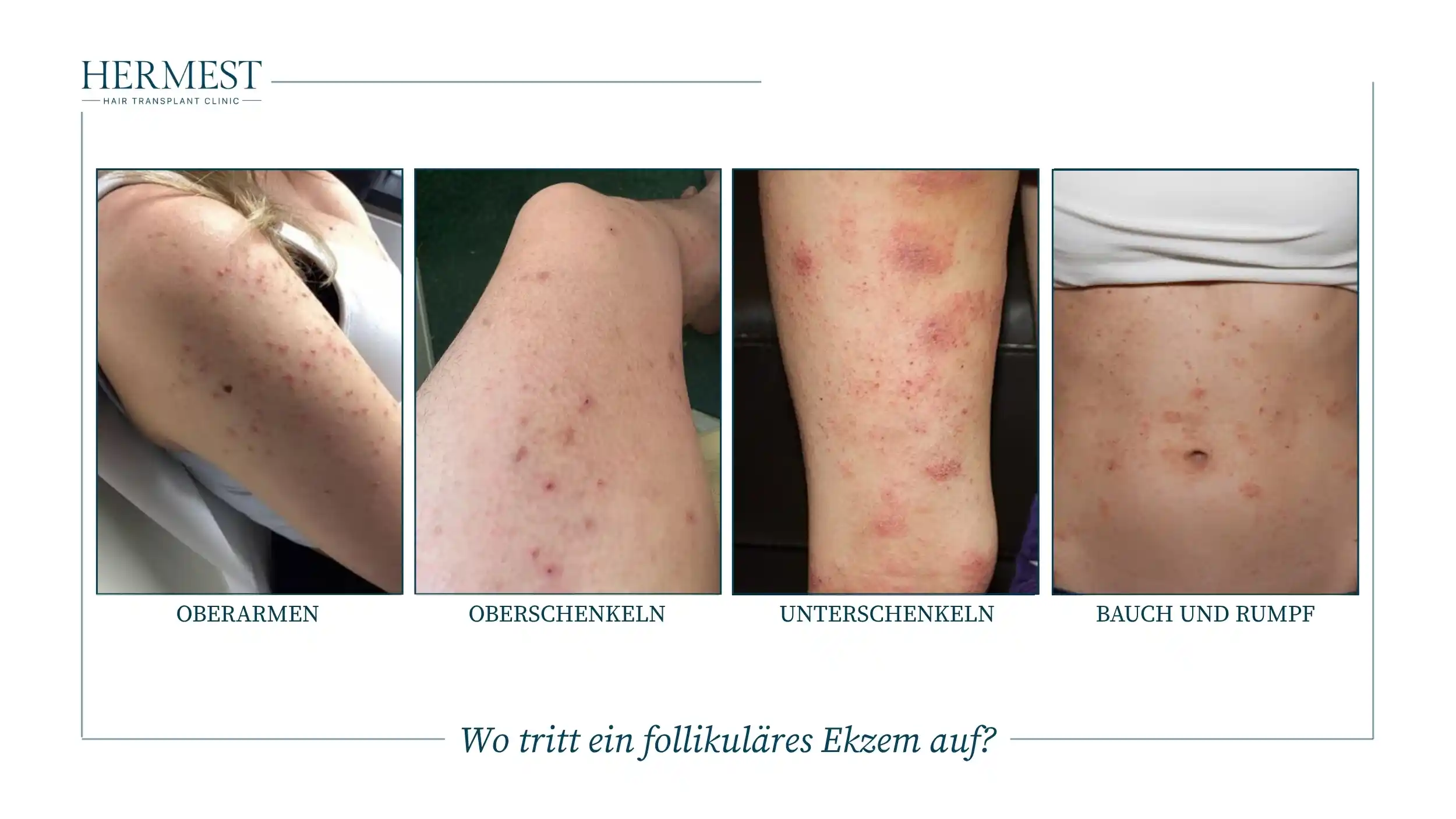 Wo tritt ein follikuläres Ekzem auf